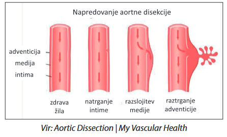 aortna disekcija